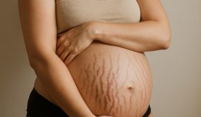 kesan czer, stretch mark