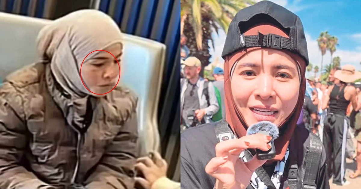 Foto Ardell Tular Di Media Sosial, Jelas Kesan Lebam Di Muka Buat Ramai Sebak – “Luluhnya Hati Tengok..”