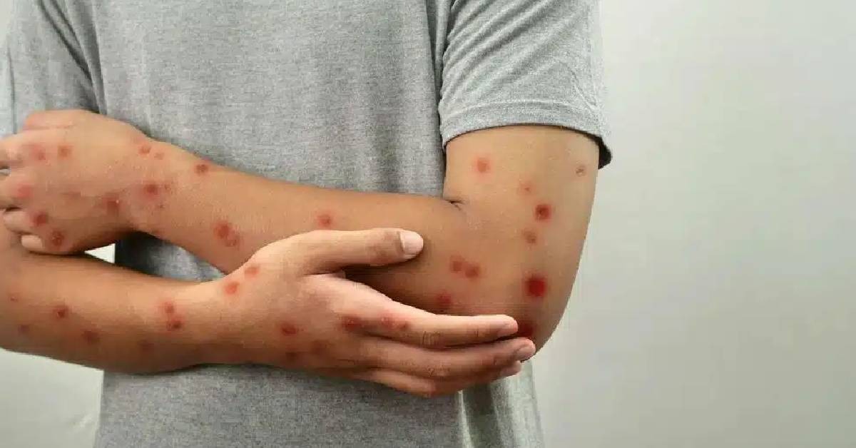 Singapura Catat 2 Kes Baru Varian Mpox, Dikesan Melalui Kegiatan Seks