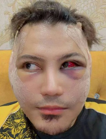 “Saya Nak Baiki Kesilapan” – Muka Berbalut, Prince Syed Nafi Buat Pembedahan Plastik